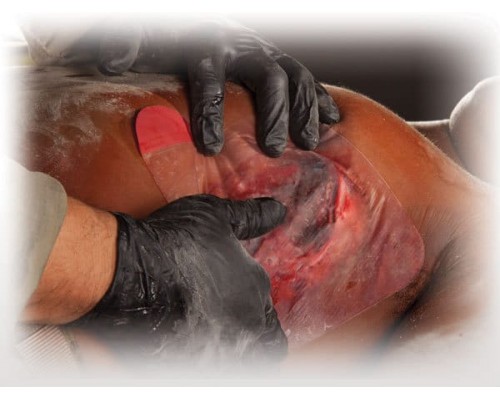 Прозрачный клейкий пластырь (6х6 дюймов) HyFin Chest Seal North American Rescue Прозрачный клейкий пластырь (6х6 дюймов) HyFin Chest Seal North American Rescue